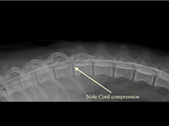 Myelogram Herniated Discs